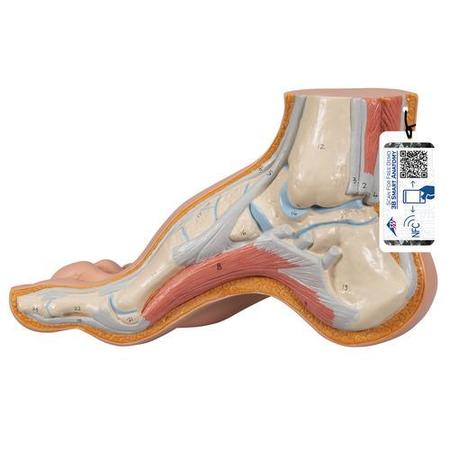 3B SCIENTIFIC Hollow Foot (Pes Cavus) - w/ 3B Smart Anatomy 1000356